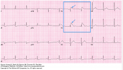 "The RBBB pattern, with ST elevation in V1 & V2 is indicative of Brugada Syndrome.

What is the main concern for patients with this syndrome?"