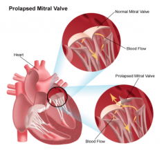 "Mitral valve prolapse.

Excess tissue makes the valve floppy, May be associated with Marfan's and Ehler's Danlos"