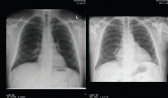 In a case of pericardial effusion what diagnostic tests would you order and what would they show?