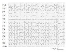 4 yO boy presented with deterioration in his behaviour and language skills during the past 2 months. 
EEG recording during sleep showing epiletiform activity in more then 85% of non REM sleep