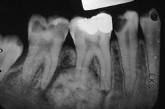 The cemento blastoma obscures the root, while the condensing osteitis doesnt