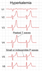 "Peaked T-waves,
Small or absent P-waves,
QRS prolongation,
Conduction blocks."