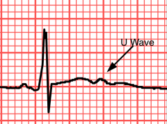 "1) Characteristic U-wave;
2) T wave flattening,
3) Atrial or ventricular tachyarrhytmias,
4) ST depression and T wave flattening,
5) Prolonged QT interval."