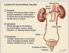 "Pre-renal (decreased perfusion, normal nephron structure and function) - 20-30%

Renal (abnormal structure and function of nephrons) - 50-60%

Post-renal/obstructive (urine outflow passages are blocked and secondarily abnormal function of the...