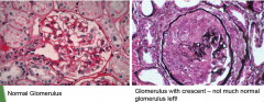 "Used for definitive diagnosis

Crescents=sign of severe glomerular injury. They are an accumulation of epithelial cells and circulatory monocytes/macrophages in Bowman's space."