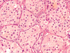 Mickuliz syndrome,  auto immune disease like Jogren syndrome

can manifest as the inflammation of both parotide glands

 

The pathognomic sign is Histological:

Epimyoepithelial islands