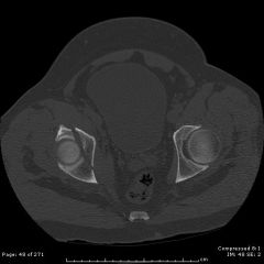  A 42-year-old female sustains the injury seen in the computed tomography images seen in Figures A and B. According to the Letournel classification, what is the injury pattern shown?

1.  Posterior wall

2.  Transverse

3.  Anterior w...