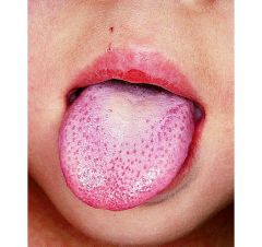 what is this disease called strawberry tongue in a child with  a rash his body