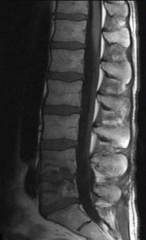 Seeding of bone related to a previous bacteremia (e.g., vertebral bodies and disc are irregular and loose; bacteria got into disc and then spread into vertebral bodies)