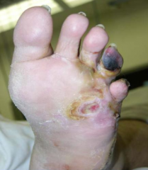 Direct spread of bacteria from an overlying wound or pressure ulcer (common in diabetes)
