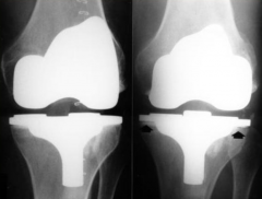When there is an infection on the prosthetic material that is implanted in the bone, it spreads to the adjacent bone
(picture: before & 3 months later)