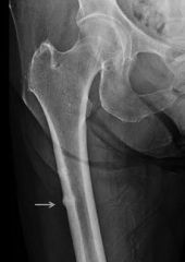 Subtrochanteric stress reaction and fracture is a known complication of longterm bisphosphonate use. Imaging typically shows lateral cortical thickening in the subtrochanteric femur (Illustration A). Without discontinuation of bisphosphonate use a...