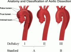 1. tear in the inner wall of the aorta causes blood to flow between vessel/intimal wall layers, forcing them apart
2. Type A- involves ascending aorta +/- arch- may spread retrograde into heart--> tamponade
Type B- involves descending aorta or arch