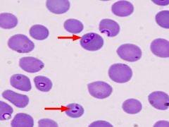 How can we diagnose babesiosis?