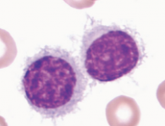  What's Hairy
Cell
Leukemia?

What are the lab findings?