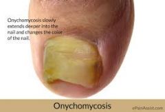 
- aka dermatophytosis of the nail
- chronic disfiguring disorder of the nail
- nails are dull, thickened, lusterless

Dx: hyphae of nail scrapings mixed with KOH

Tx: antifungals (diflucan)