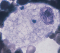 Niemann
- Pick Disease    
(Lipid storage disorder)

Foam cell
Deficient
enzyme: sphingomyelinase      