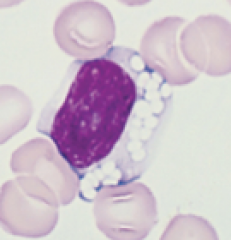 This type of cell abnormality is seen in which lipid storage disorder?