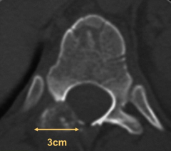 Osteoblastoma (found in vertebrae, >2cm)