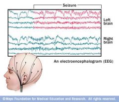 What is the Electroencephalogram for (EEC)?