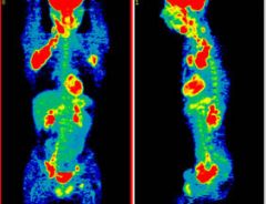 What is the PET SCAN?
