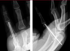 The clinical presentation is consistent with a transverse proximal phalanx fracture. These fracture have an apex palmar angulated deformity under the indirect pull of the central slip on the distal fragment and the interossei insertions at the bas...