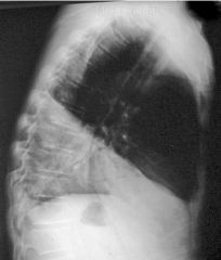 LateralCXR similar to this given: 


a) ??Maybe lingular consolidation 
b) Artefact from the patient’s arm 
c) Right middle lobe consolidation 
d) Left lower lobe consolidation 
e) Right lower lobe consolidation