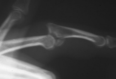 Hx:28yo professional baseball player injures his middle finger sliding into the catchers shin guard at home plate. c/o pain and deformity of the middle finger. xray fig A. All are true EXCEPT: 1-Anatomic reconstruction of the articular surface is ...