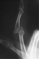 a dorsal fracture dislocation of the proximal interphalangeal joint of the middle finger. Kiefhaber and Stern review the presentation, evaluation, and treatment of PIP fractures. Congruent reduction of the joint to allow the middle phalangeal to g...