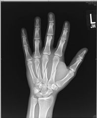 Hx:25yo F is involved in a motorcycle collision and presents with the injuries seen in Fig A. What is the best option for definitive management of the injuries seen? 1-ORIF; 2-CR & casting; 3-Ex-fix; 4-Immediate therapy; 5-Removable splint