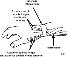 a inflammatory response to overuse at the site of the second dorsal compartment crossing under the first dorsal compartment approximately 5 cm proximal to the wrist. An anatomical depiction is provided in illustration A. Injections of the second d...