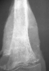 Osteosarcoma:
- Poorly delimited neoplasm, bone destruction, cortical disruption
- Codman's triangle (raised periosteum away from bone d/t new subperiosteal bone)
- Soft tissue extension
- Starts at metaphysis / medullary cavity of long bone (...