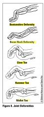 also:
- ulnar deviation of mcl; radial deviation of wrist joint
- flexion contractures