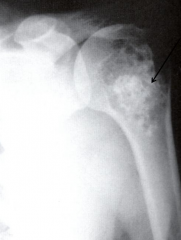 - Ring and arc appearance (popcorn-like)
- Frequently present calcifications, which tend to be lost in grade 3 tumors
