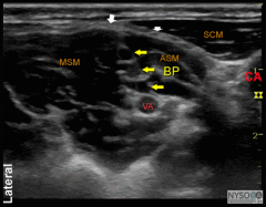 3 traffic lights between the scalene. 
the phrenic nerve is anterior to BP ?up under SCM.