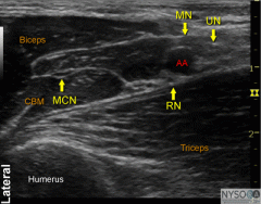 the individual nerves may not be identified. aim to donut the artery with LA. 
CBM=coricobrachialis muscle.