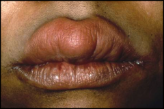 What can this pathology be in a patient who accidently bit his upper lip