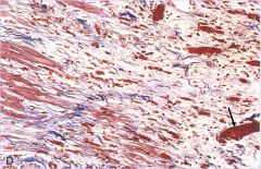 How old is the infarct in this tissue in this trichrome stain?


 


What is the arrow pointing to?