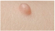 Description: flat, circumscribed area that is a change in the color of the skin;   < 1 cm in diameter

Example: Freckles, flat moles (nevi), petechiae, measles, scarlet fever, lentigo