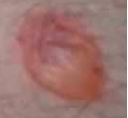 Description: Vesicle > 1 cm in diameter


Example: Blister; pemphigus vulgaris