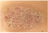Description: Small, rough growth


Example: Verruca plantaris, HPV