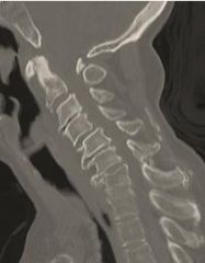 The patients symptoms are consistent with progressive cervical myelopathy. Her symptoms are progressive and severe, and therefore surgical decompression is indicated. She has cervical kyphosis as demonstrated on physical exam and imaging, with com...