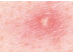 Description: Elevated, superficial lesion; similar to a vesicle but filled with purulent fluid


Example: Impetigo, acne, folliculitis