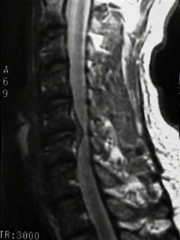 A 45-year-old man presents with increasing difficulty ambulating normally and clumsiness when he is either combing his hair or buttoning his shirt. A sagittal cut of his MRI is shown in Figure A. What is the next most appropriate step in managemen...