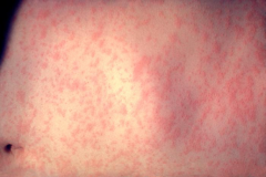 Causative: Measles; viral exanthem; systemic illness

Symptoms: Three C's - cough, coryza (runny nose) and conjunctivitis; Koplik's spot (white lesion, red halo, buccal mucosa)

Differentials: Abdominal pain, OM, and bronchopneumonia associated; I...