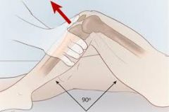 Knee flexed 90 degrees; proximal tibia ispulled forward. If soft or missing endpoint, indicates atear of the ACL.