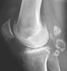 - Small fractures can dislodge pieces of cartilage and subchondral bone into the joint in Osteoarthritis
- When removed they are shiny (characteristic of cartilage)