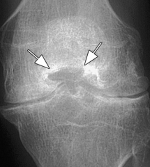Fracture gaps in bone allow synovial fluid to be force into the subchondral regions