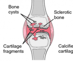 - Irregular joint space
- Fragmented cartilage
- Loss of cartilage
- Sclerotic bone
- Cystic change (subchondral cysts)