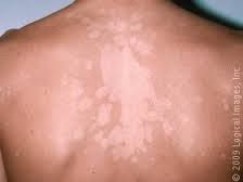 Causative: Hot   and humid climates, wearing wet clothing, prolonged use of topical steroids, immunocompromised   states.


Symptoms: Variably   colored white to pink to brown scaling upper trunk, axilla, neck, upper arms, abdomen, thighs, genital...